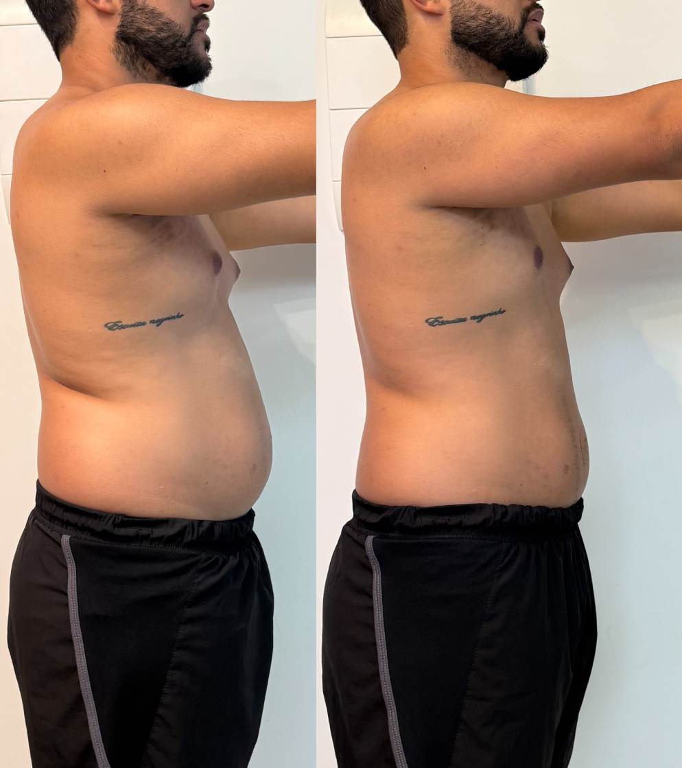 André Lucas Santiago - antes e depois